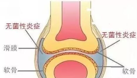 软骨.jpg
